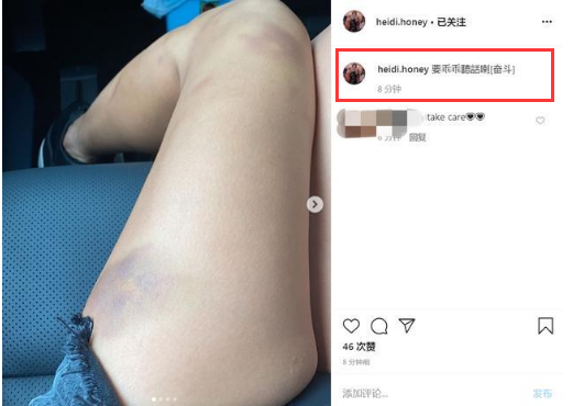 洗米嫂罕见晒受伤照，腿部多处淤青，配文引发