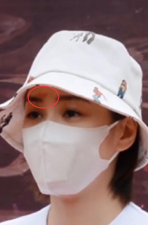 真留疤了!阿娇复工超敬业戴帽子口罩遮遮掩掩