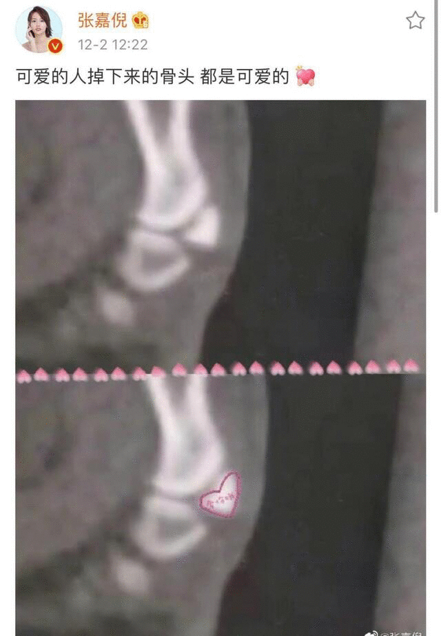 ​坐轮椅现机场，张嘉倪怎么了？